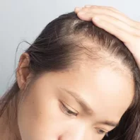 Hairloss-02 Hairloss-02